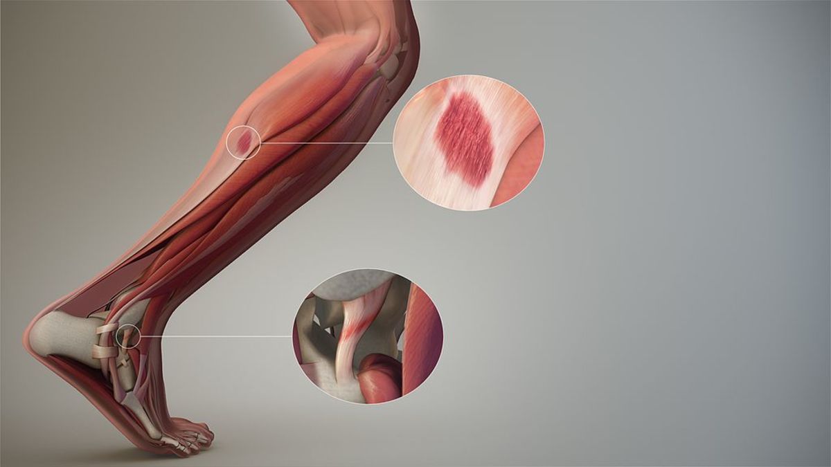 Three-dimensional animation illustrating a sprain