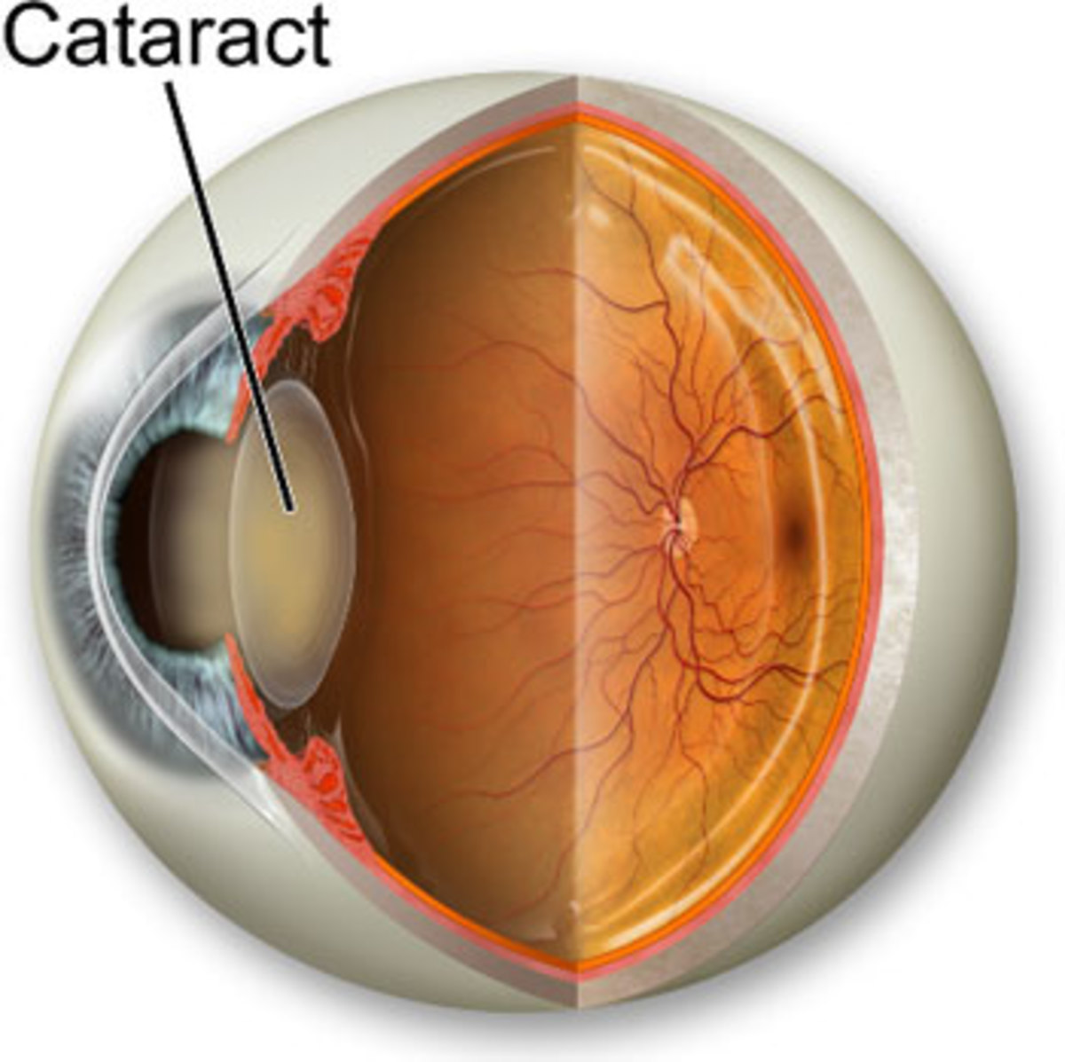 Needing and Getting Cataract Surgery and Lens Implants