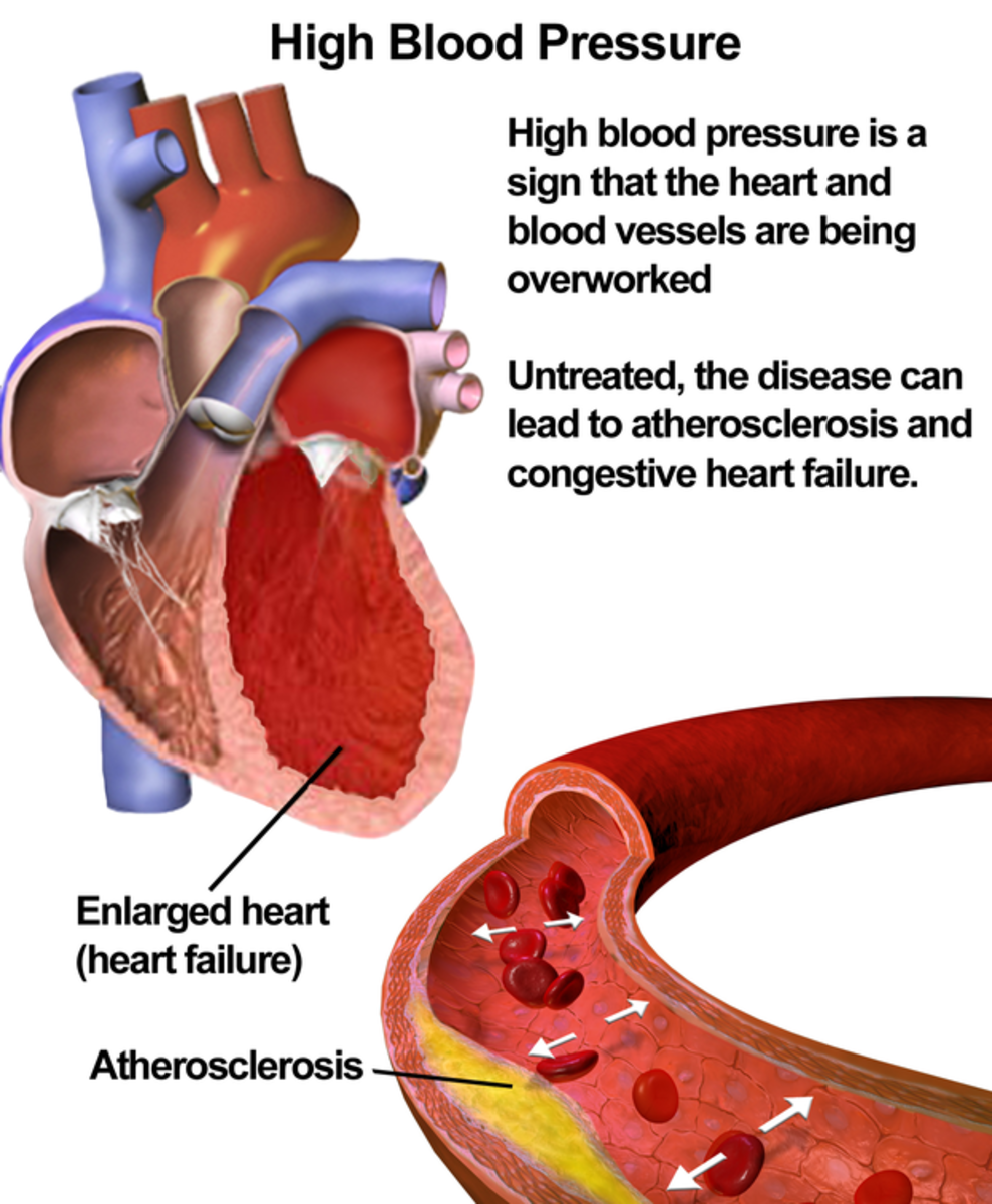 hypertension-in-seniors