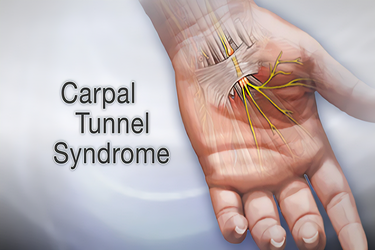 Carpal Tunnel Syndrome; symptoms, Causes, and Diagnosis, Preventions