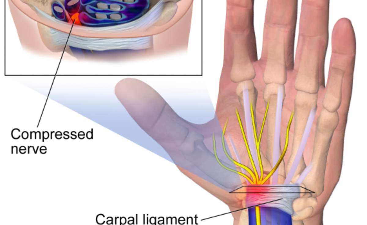 carpal-tunnel-syndrome-symptoms-causes-and-diagnosis-preventions