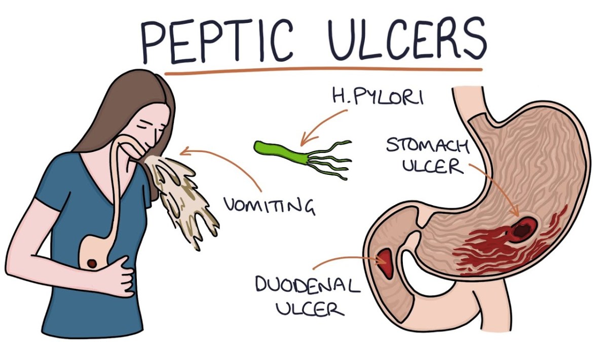 how H. pylori cause Ulcer.