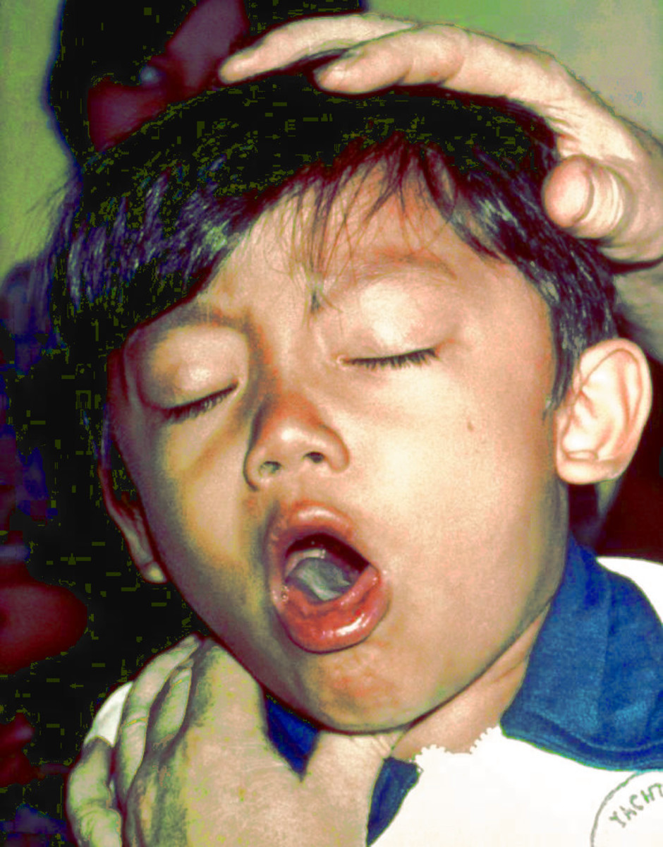 Key Information About Whooping Cough