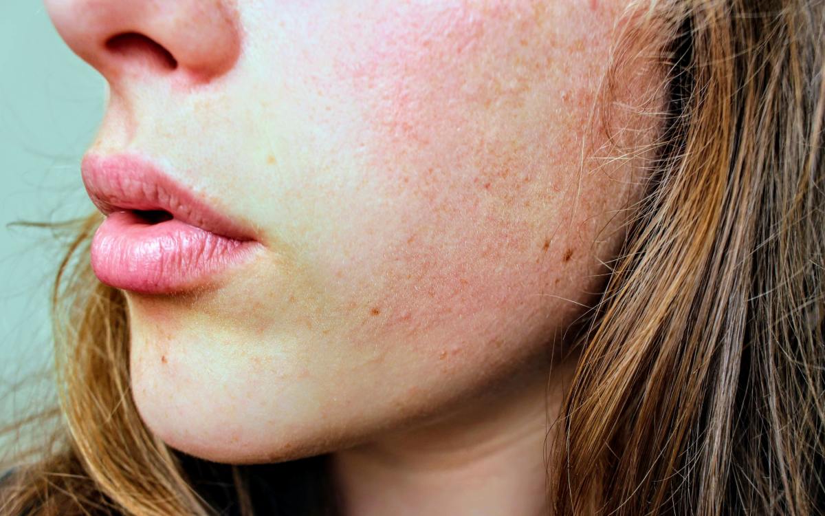 how-to-get-rid-of-dry-skin-in-winter