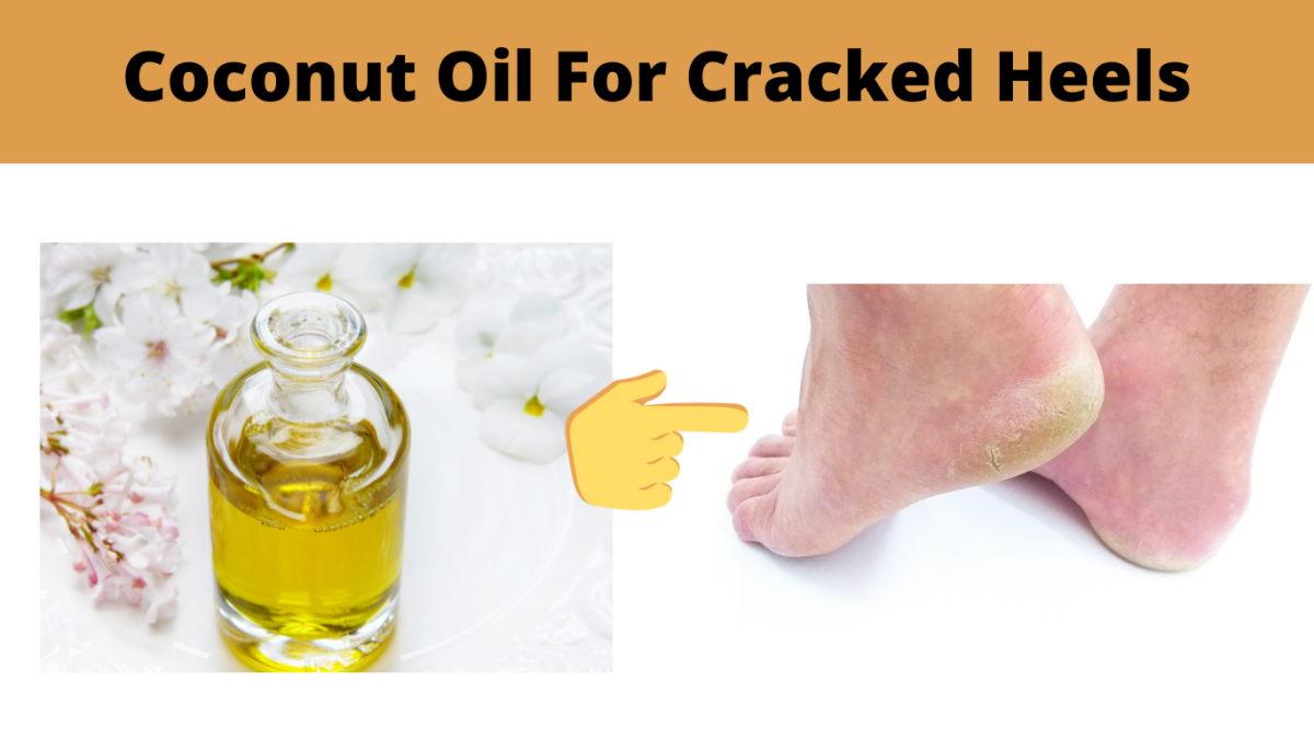 Coconut oil for cracked heels
