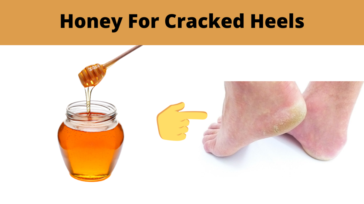 honey for cracked heels 