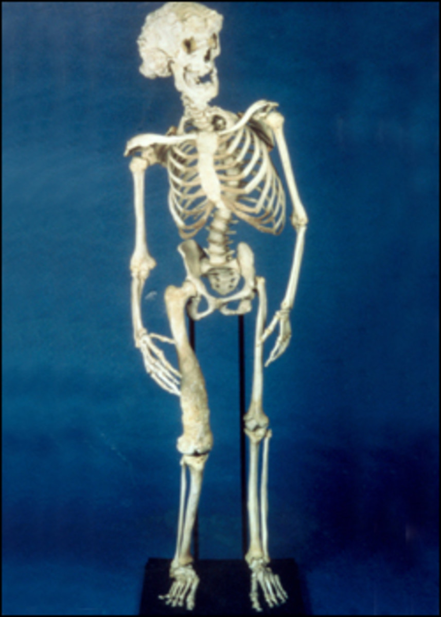 Skeleton of Joseph Merrick