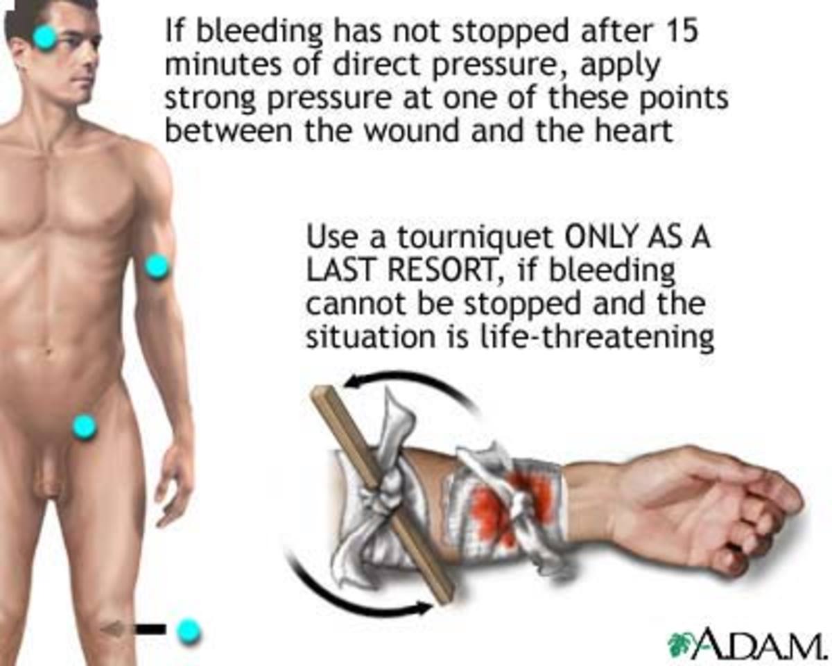 how-to-stop-a-shark-attack-victim-from-bleeding-to-death