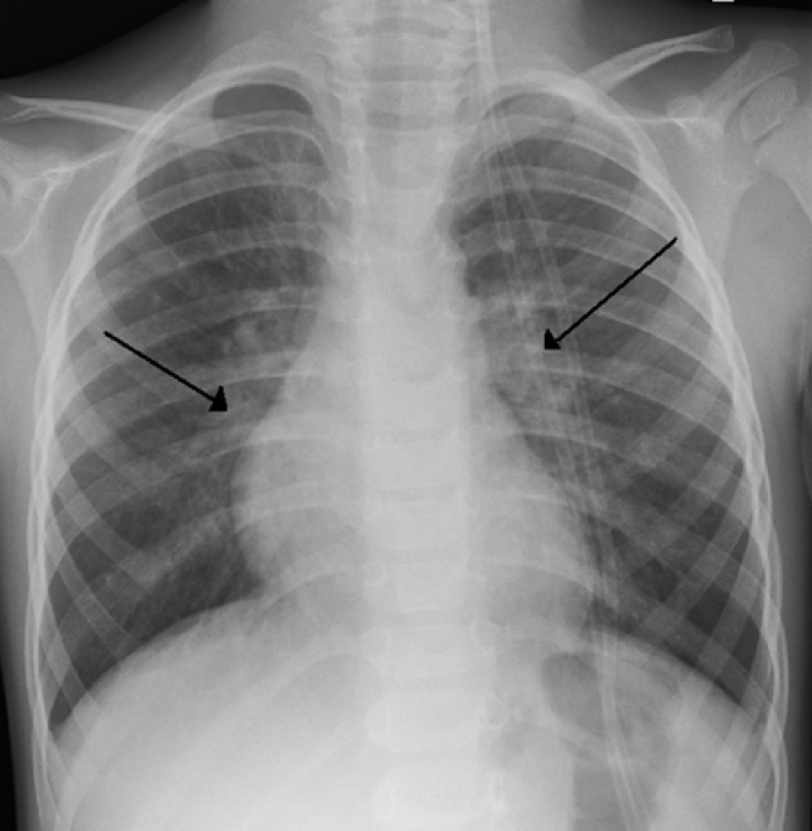 X-ray of a child with RSV bronchiolitis showing the typical bilateral perihilar fullness
