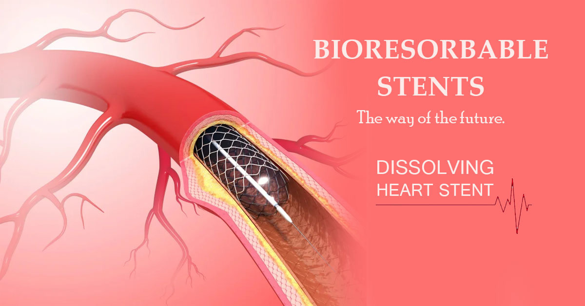 Bioresorbable Stents: The Way of the Future