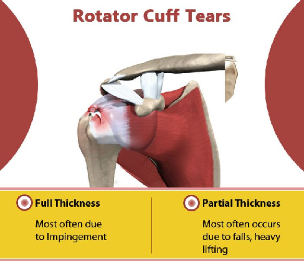 Types of Rotator Cuff Tears