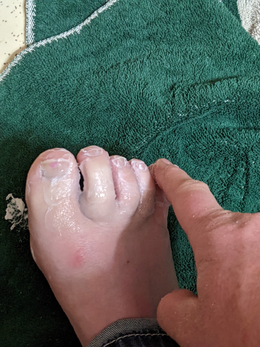 fungus-treating-feet-for-long-haul