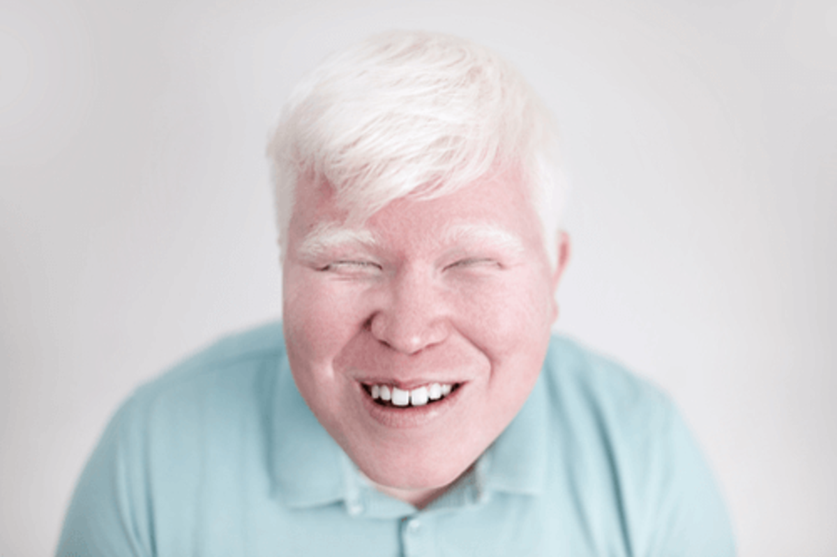 albinism-a-multi-disorder-disease