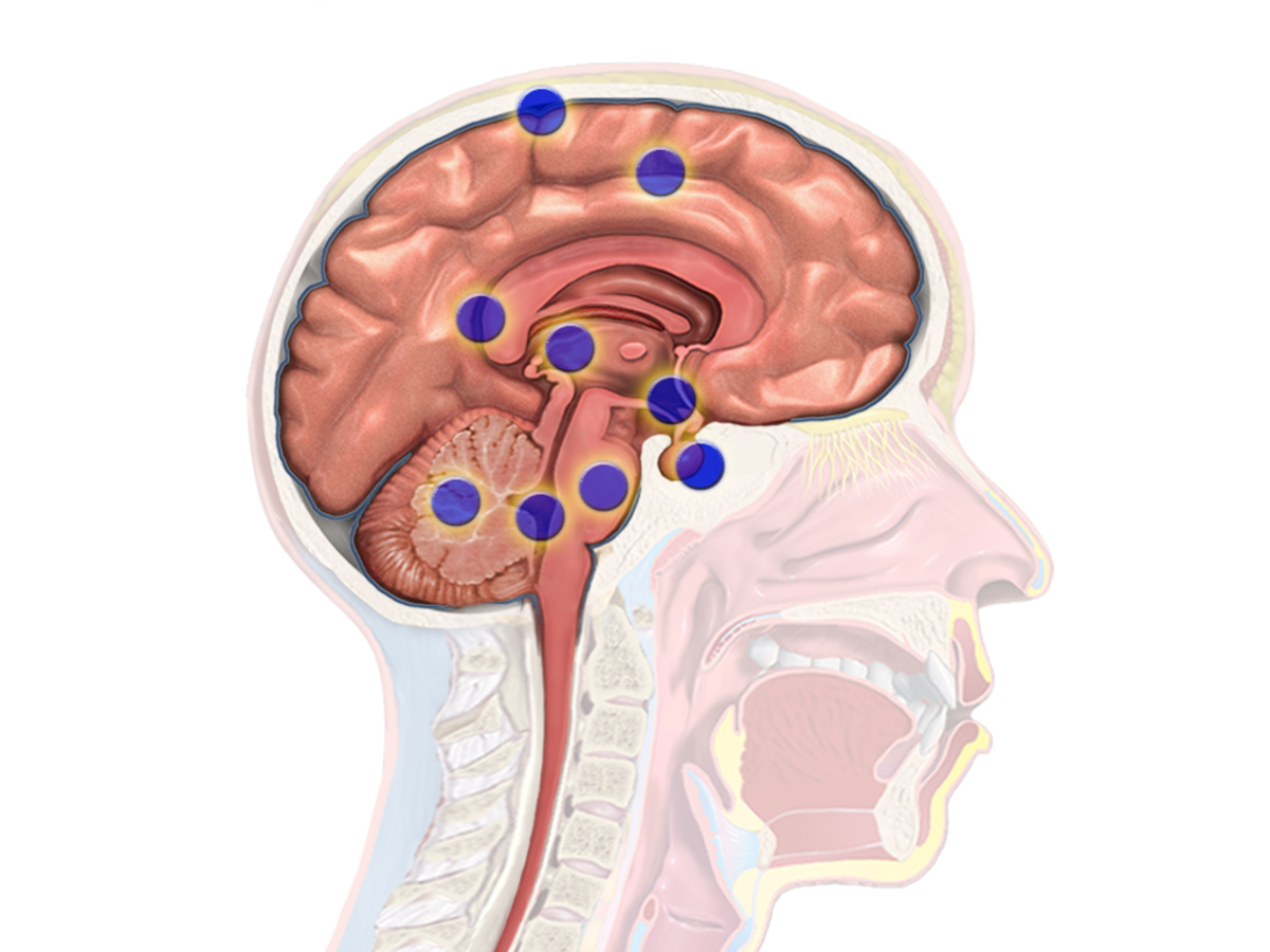 Key Information About Brain Tumor