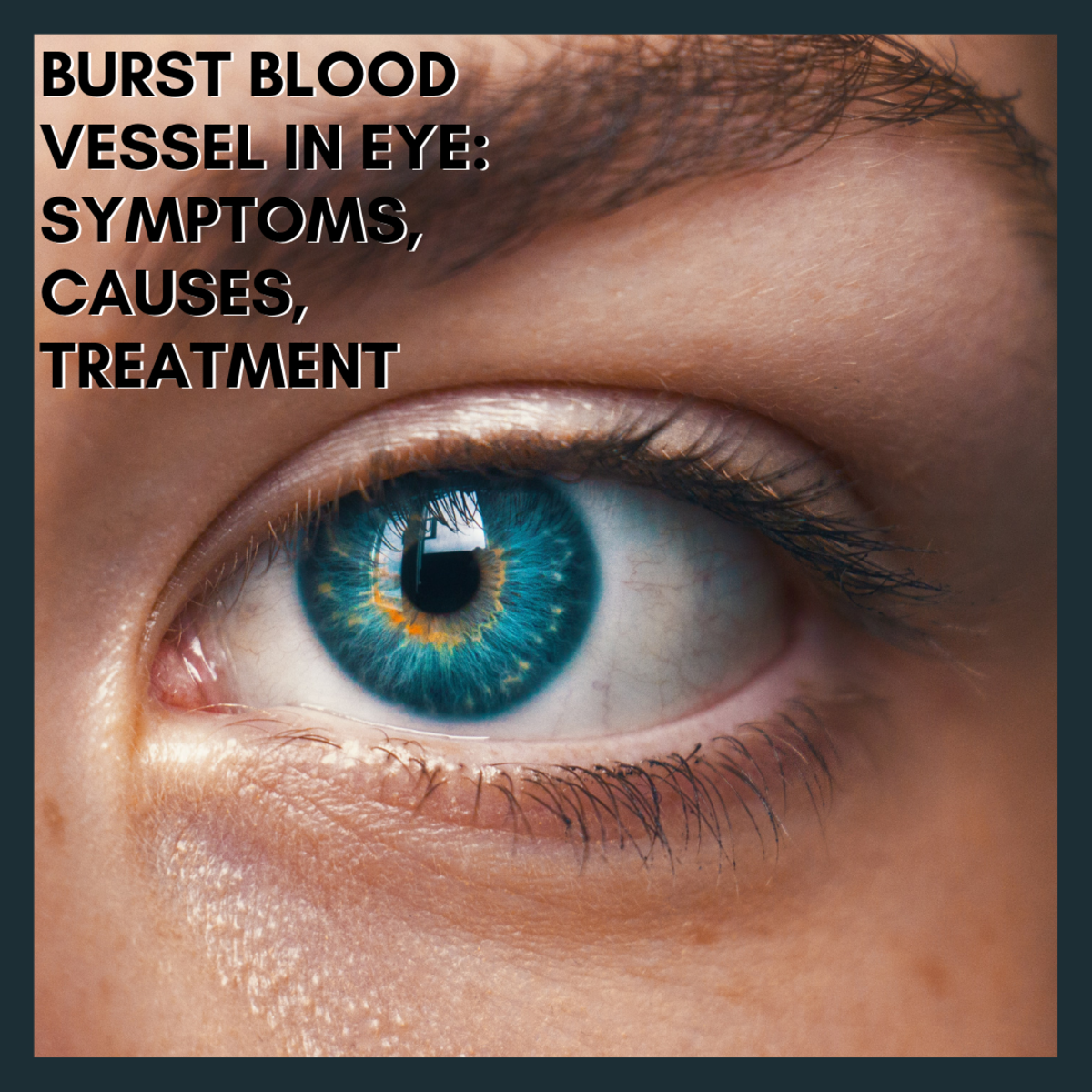 Burst Blood Vessel in Eye