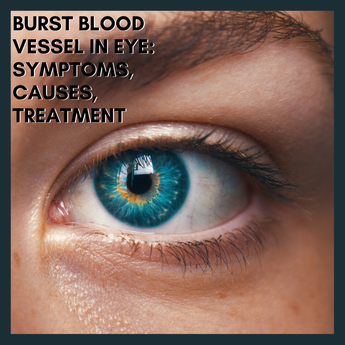 Burst Blood Vessel In Eye Symptoms Causes Treatment YouMeMindBody