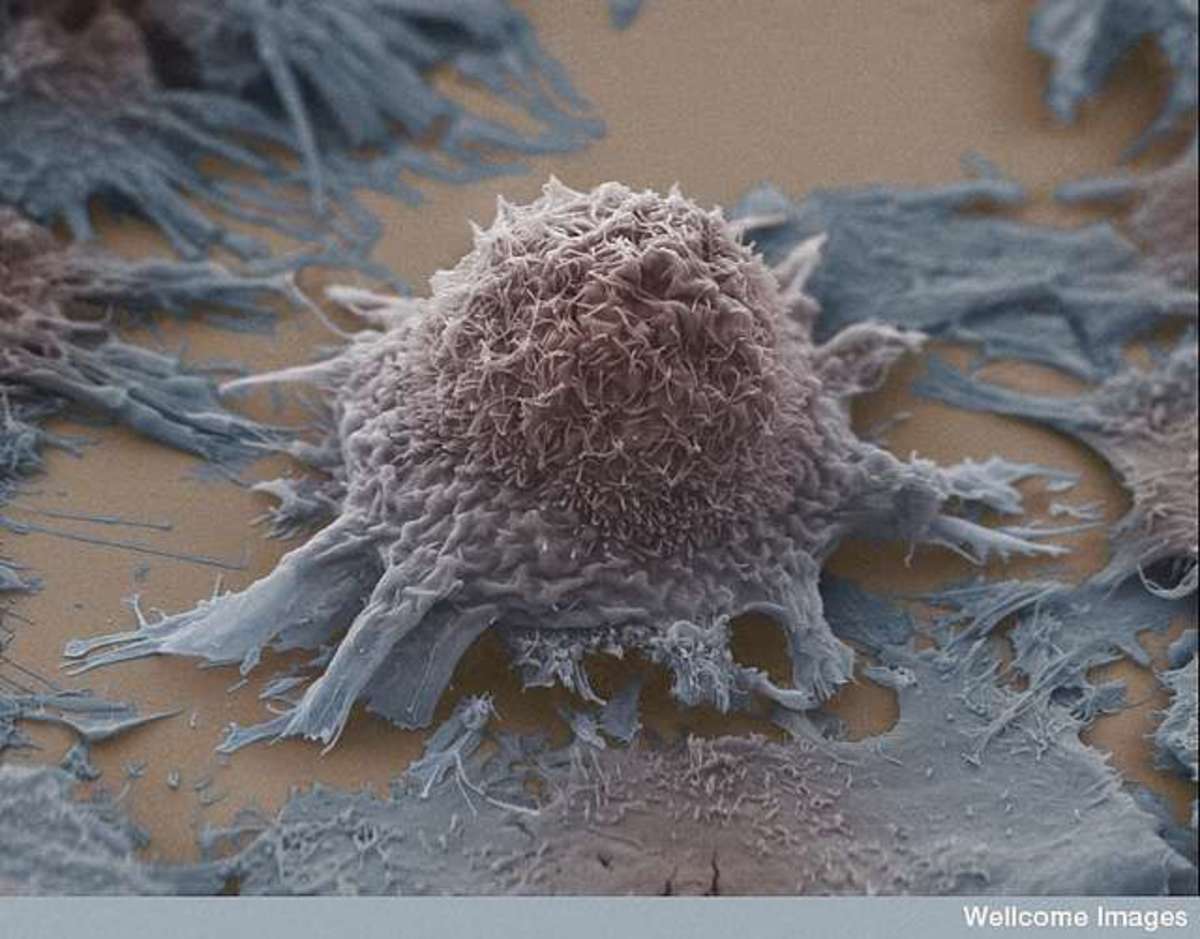 A lung tumor cell seen under a scanning electrone microscope , Anne Weston / LRI /CRUK/Welcome image/Flickr CC by nc nd 2.0