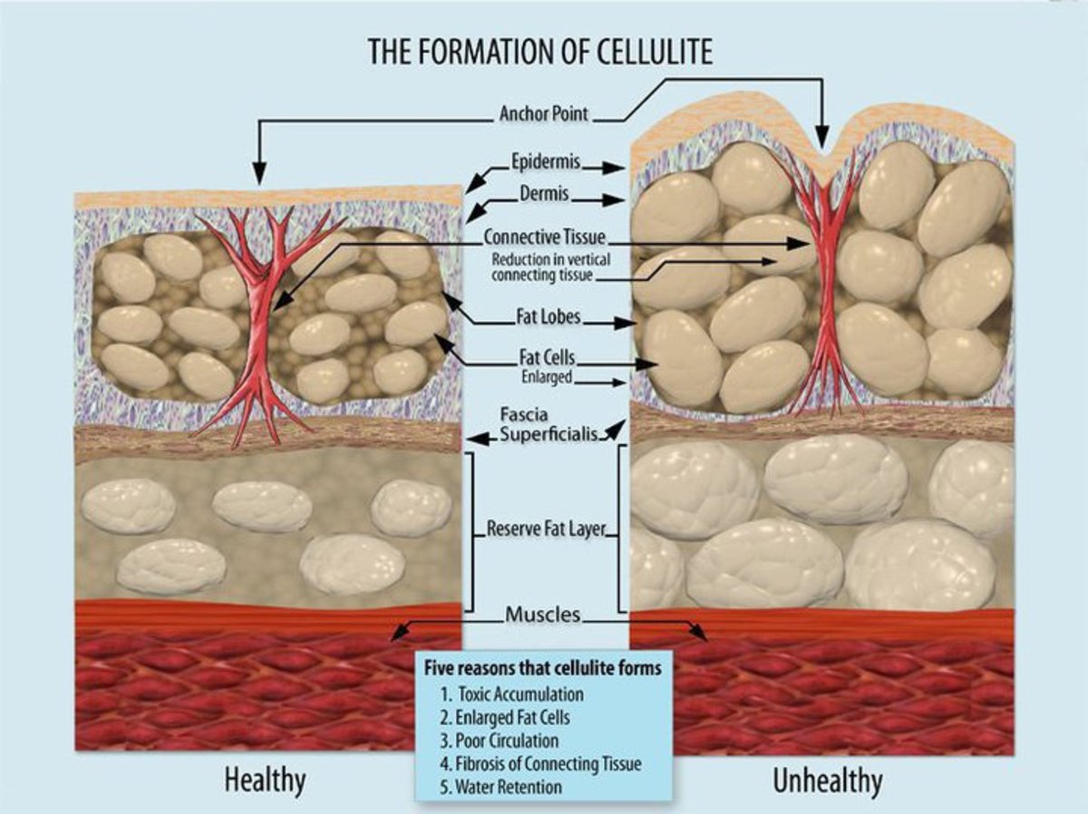 A medical illustration of cellulite.