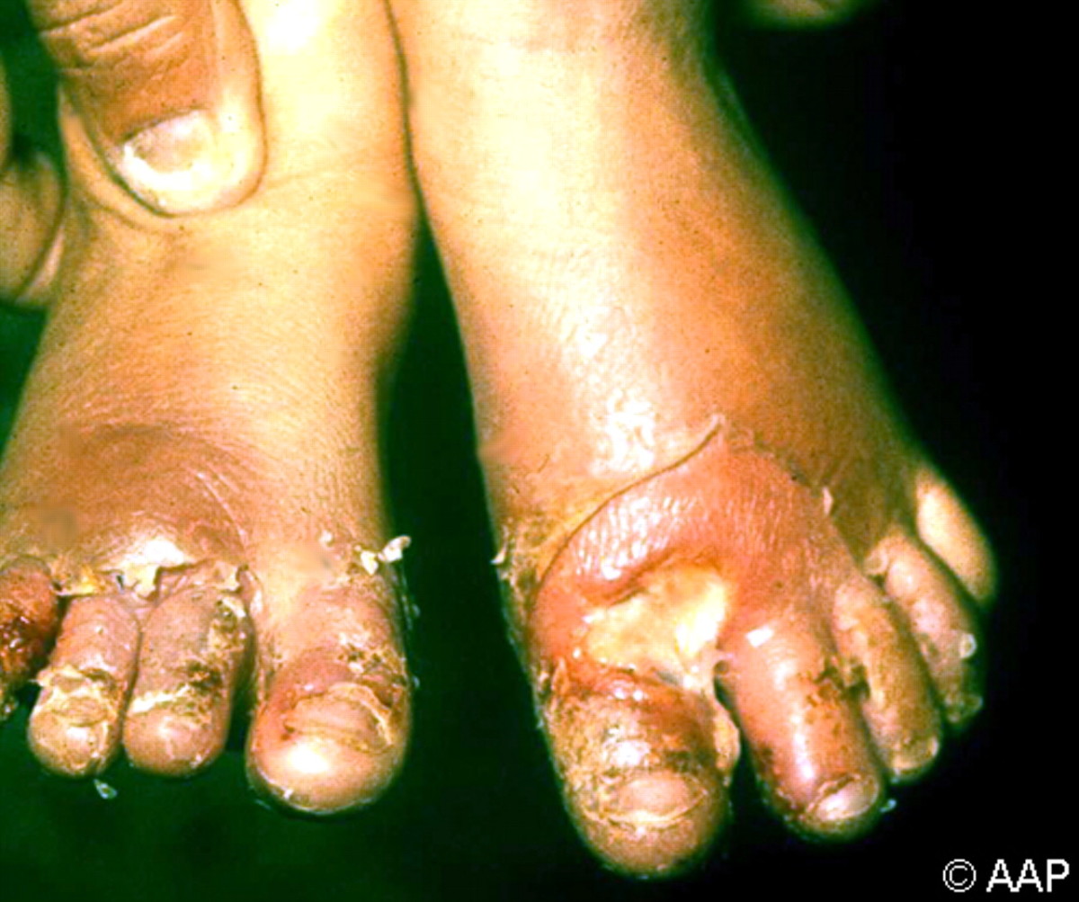 congenital-syphilis-clinical-manifestations-health-implications-and-lesions
