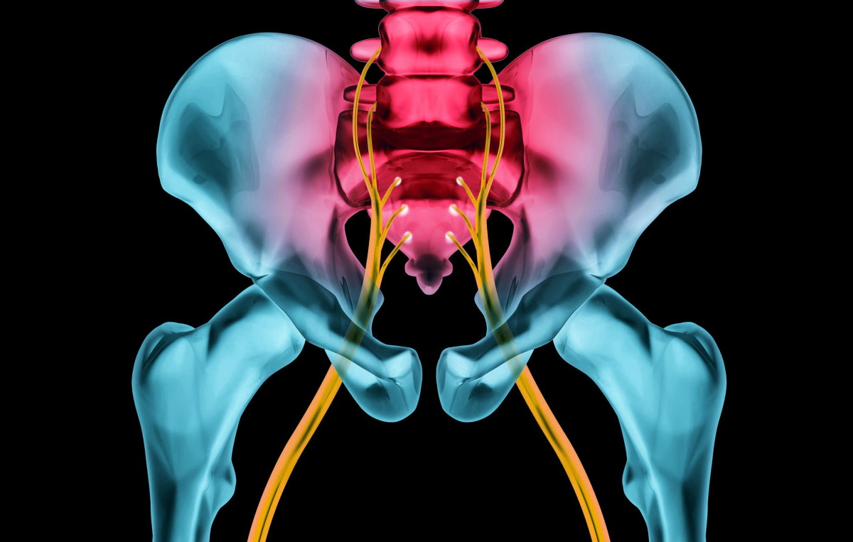 How Do You Relieve Sciatic Nerve Pain? - HubPages