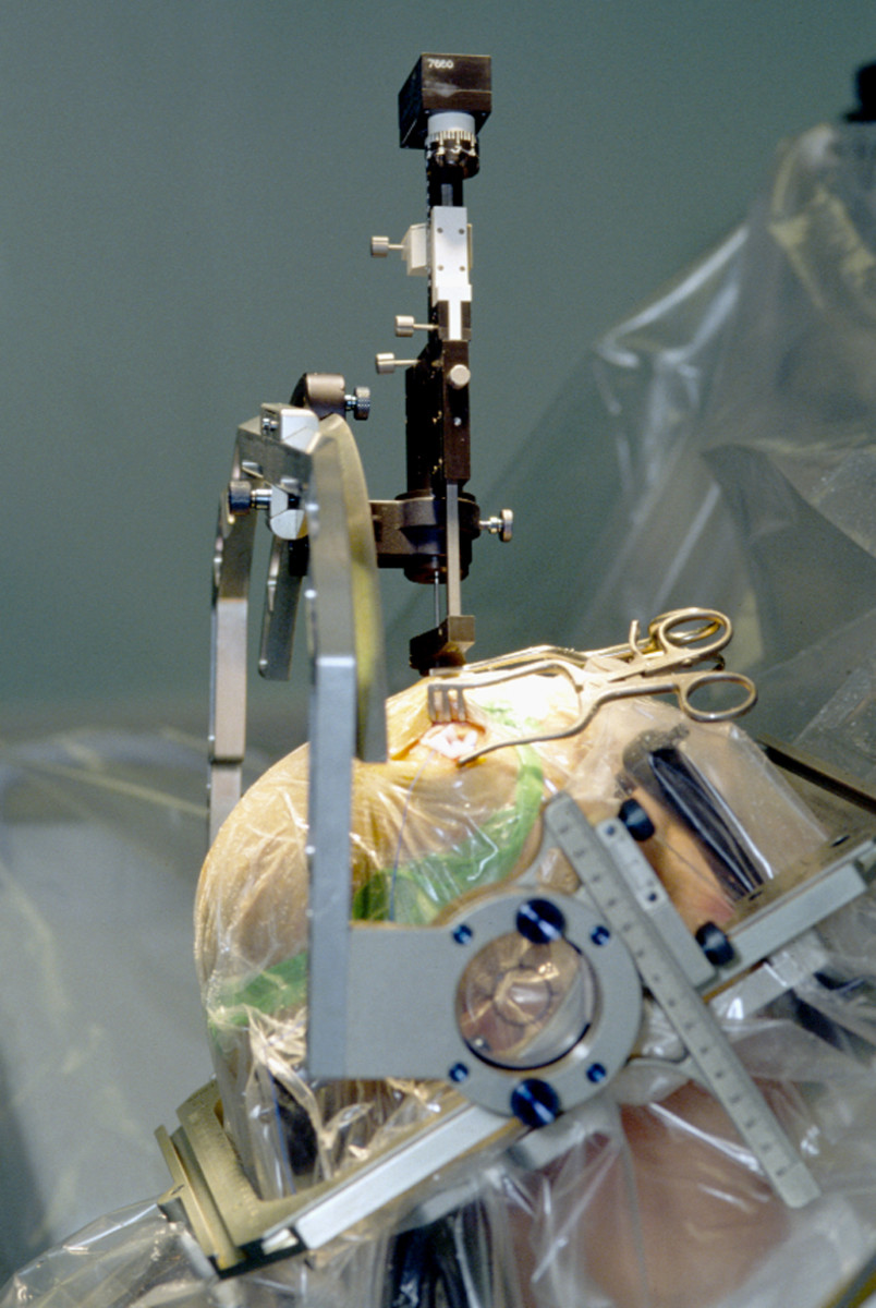Insertion of electrode during surgery using a stereotactic frame 