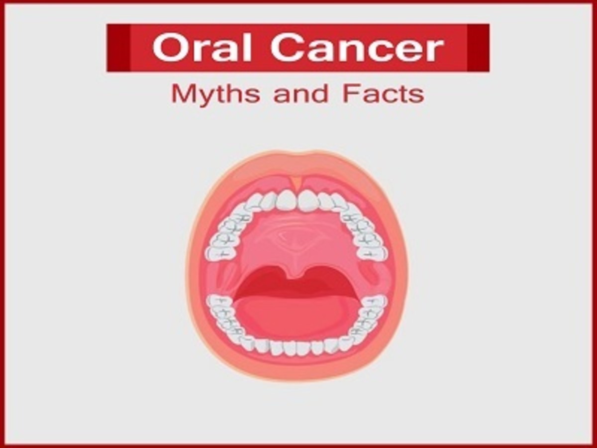 All You Want to Know About Oral Cancer Myths and Facts
