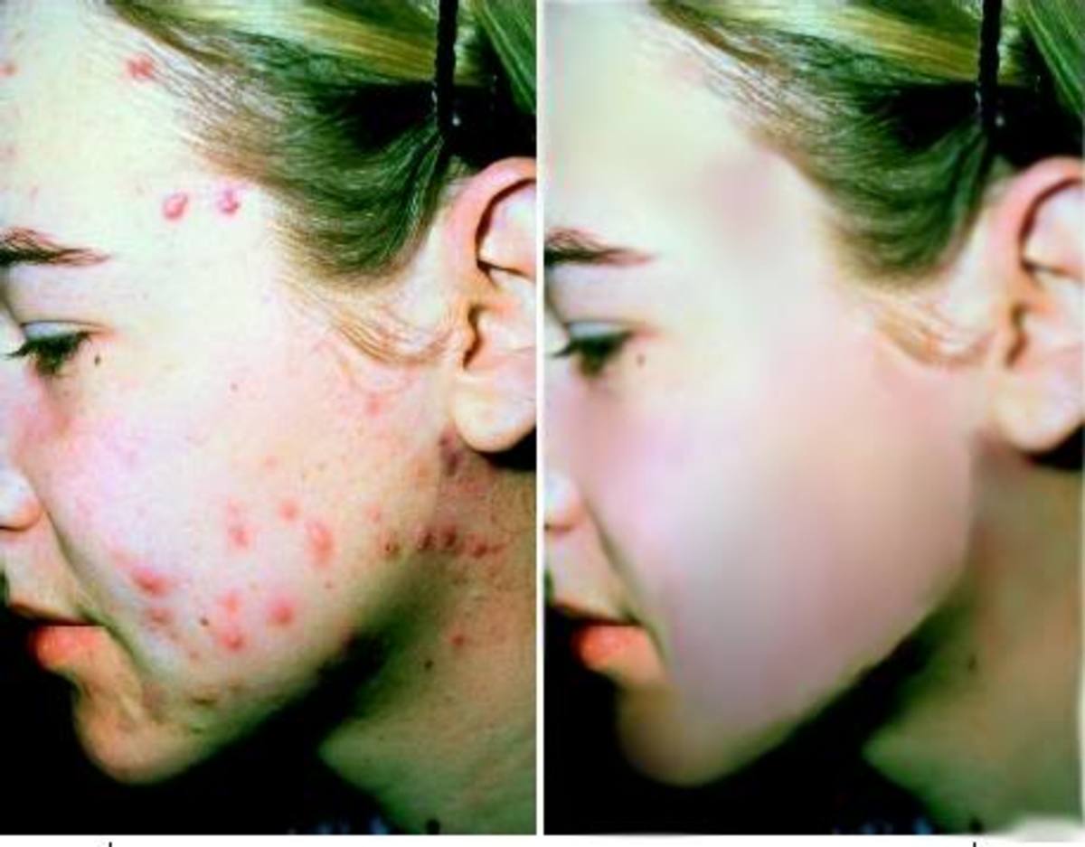 acne, photo By duckmonster_xo, source Photobucket - Which is better for your skin? Beer or Red Wine