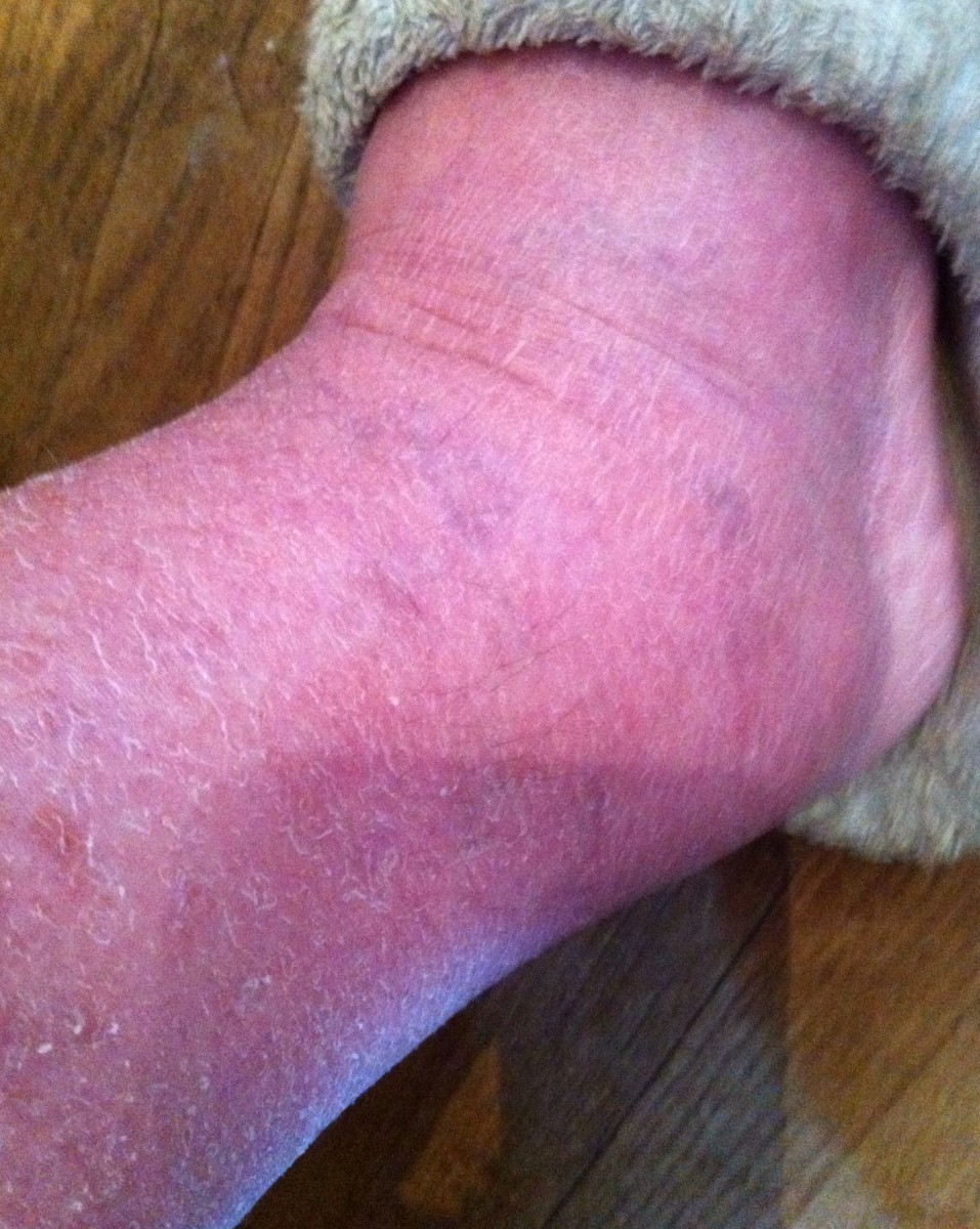 You can see how the ankle is quite swollen and the skin is dry and cracked.