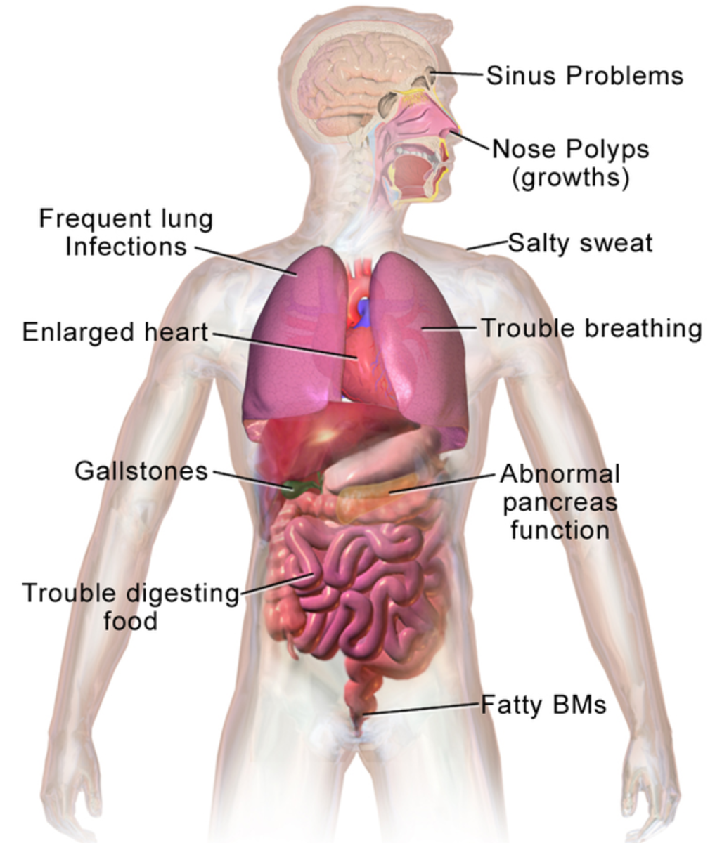 Health problems associated with cystic fibrosis. 