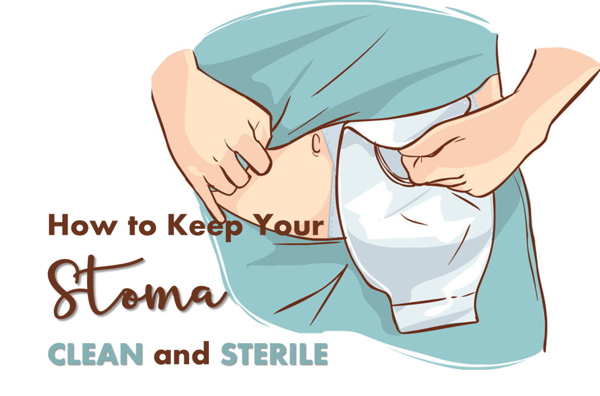 Taking Care of Your Stoma After an Ostomy