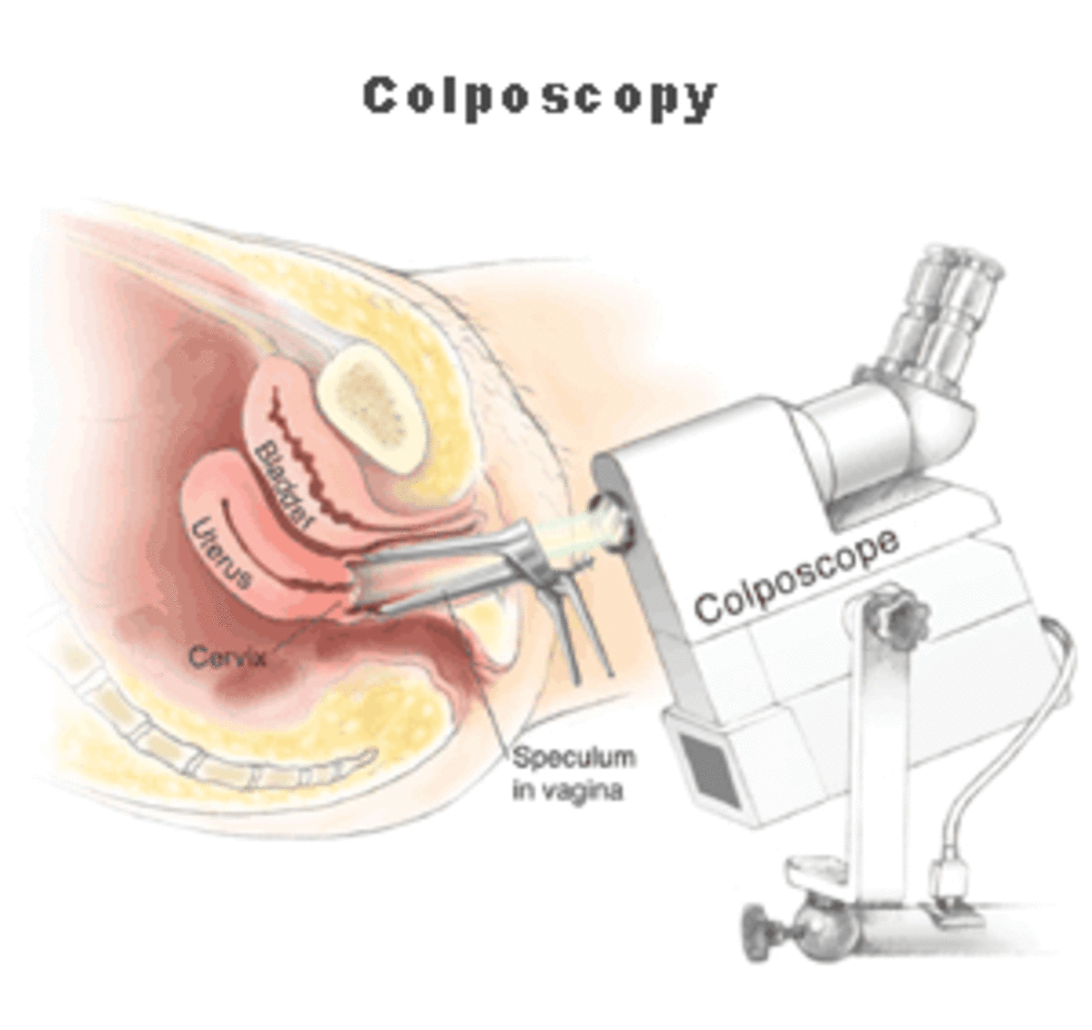 colposcopy-what-to-expect