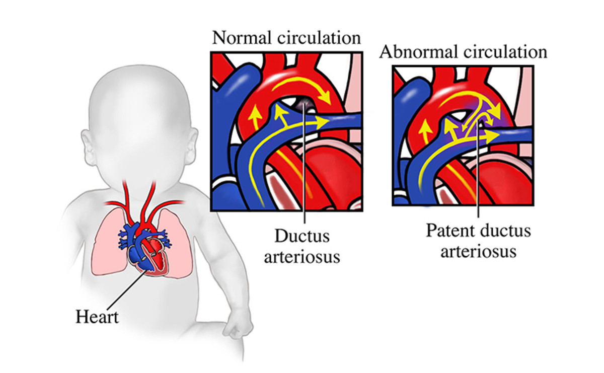 Patent Ductus Arteriosus : Pediatric Heart Defect - HubPages
