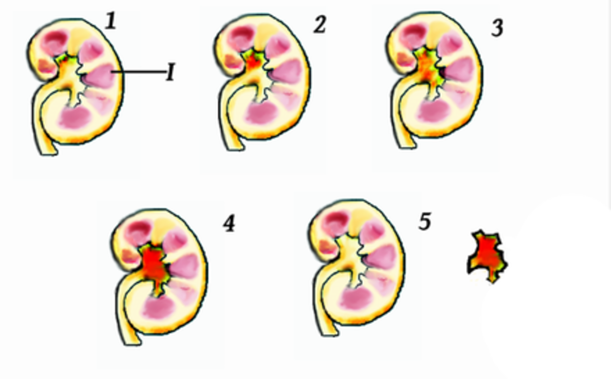 Staghorn kidney stones