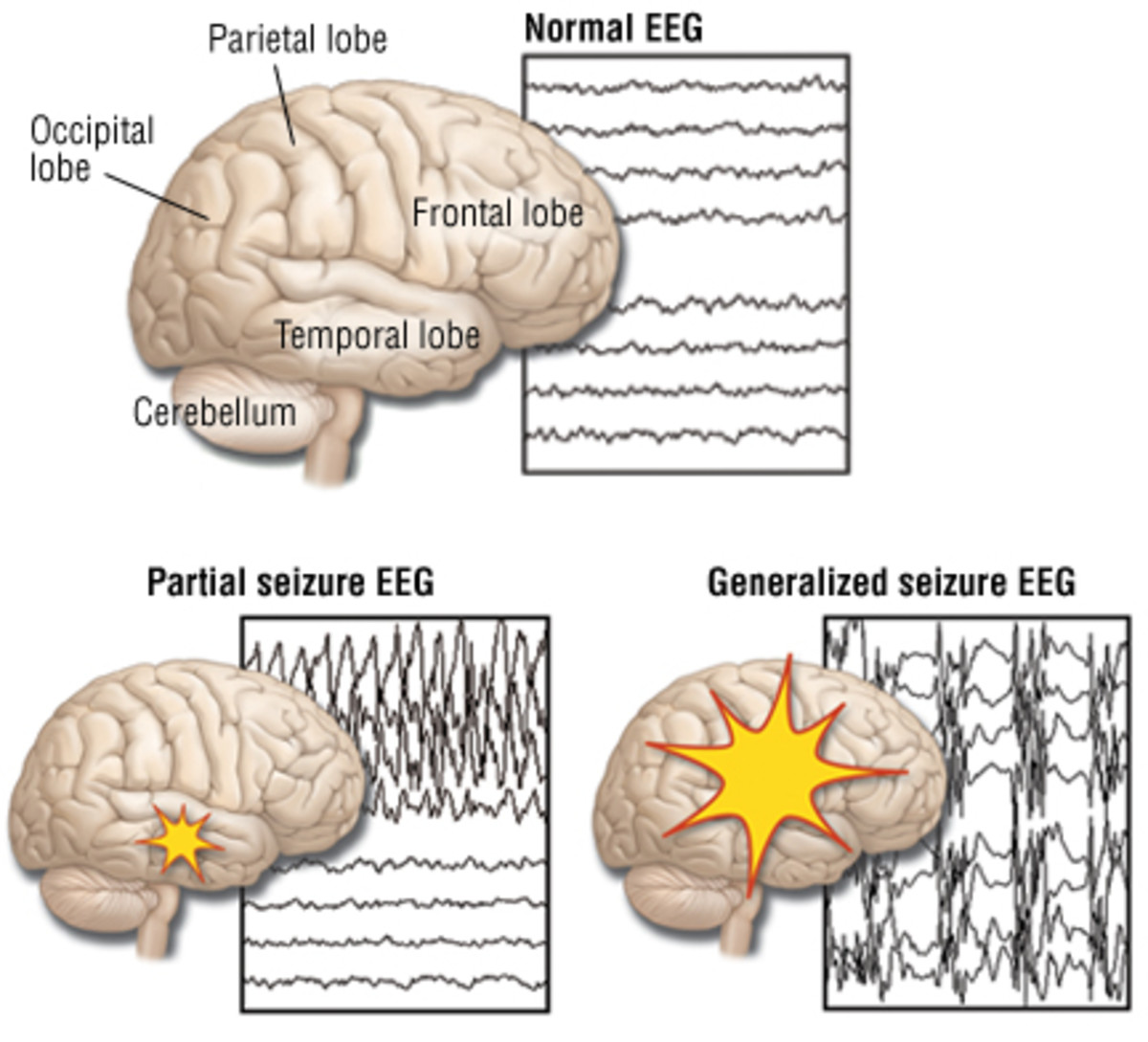 types-of-epileptic-seizures