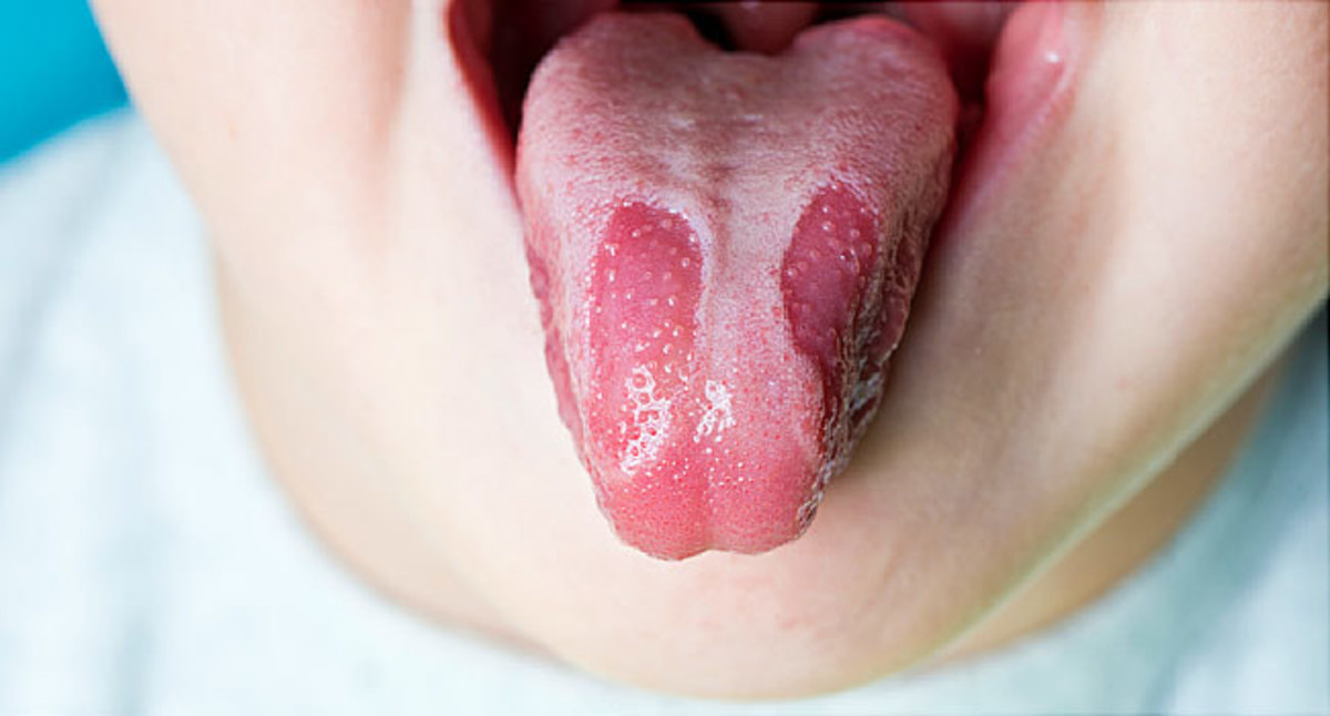 what-is-covid-tongue