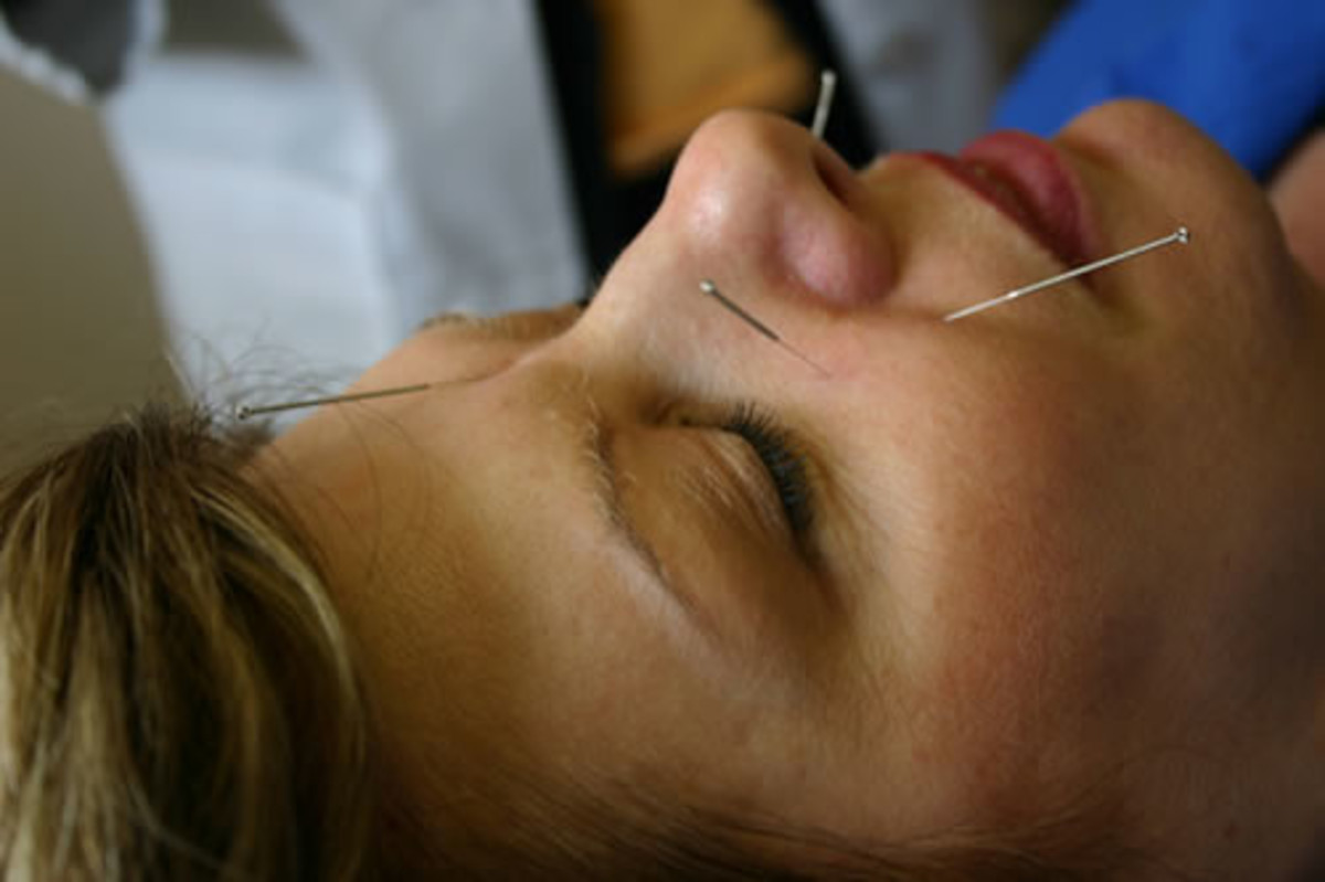 guide-to-acupuncture