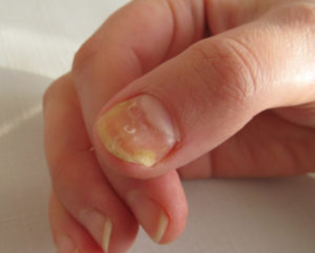 White Fungus Vs Yellow Fungus Vs Black FungusSymptoms and Prevention