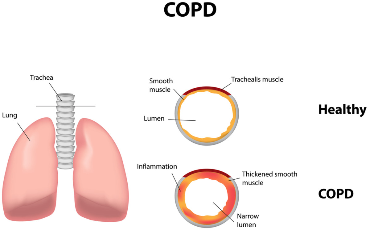 managing-copd-in-the-summer