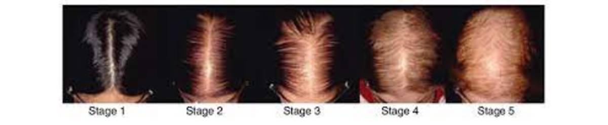 hair-loss-in-young-women