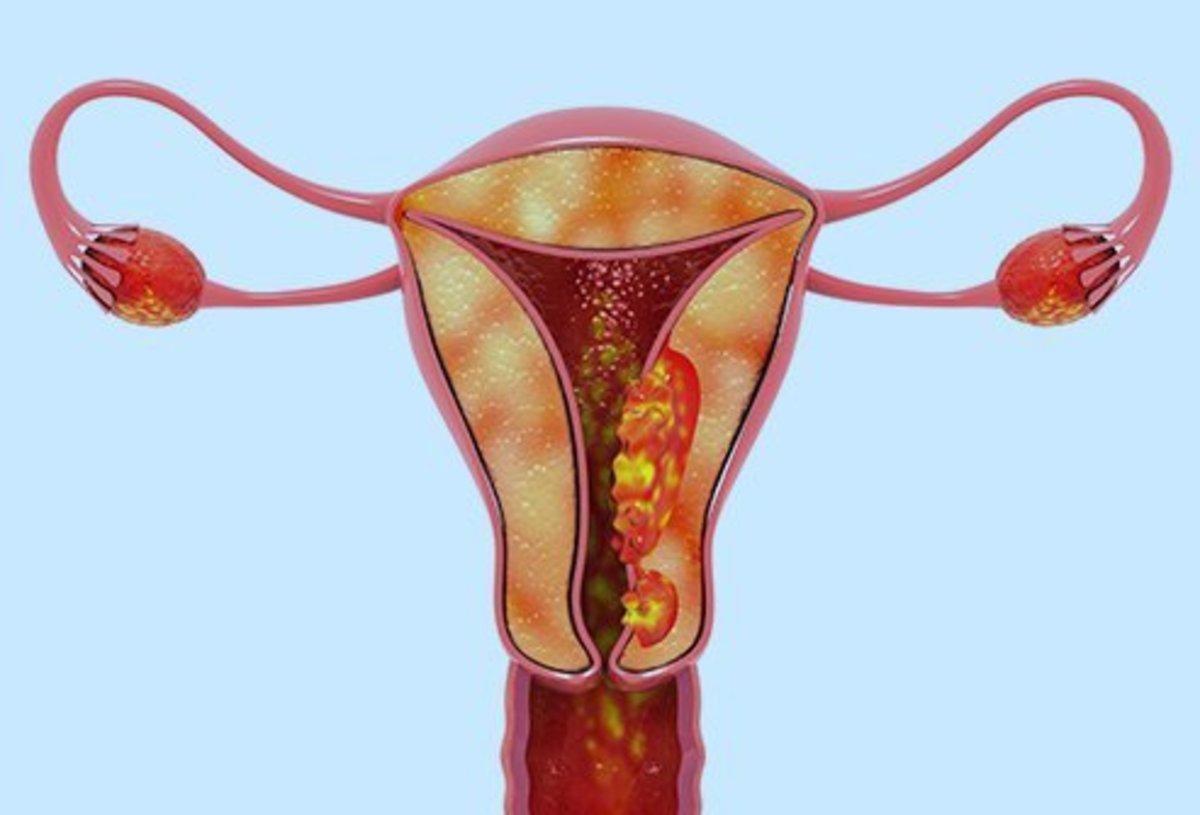 cancer of the uterine wall