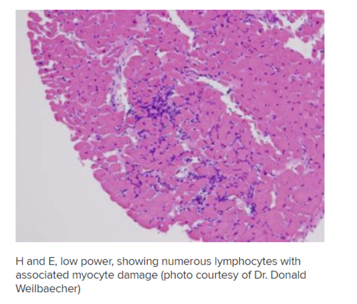 Myocyte Damage in Acute Myocarditis