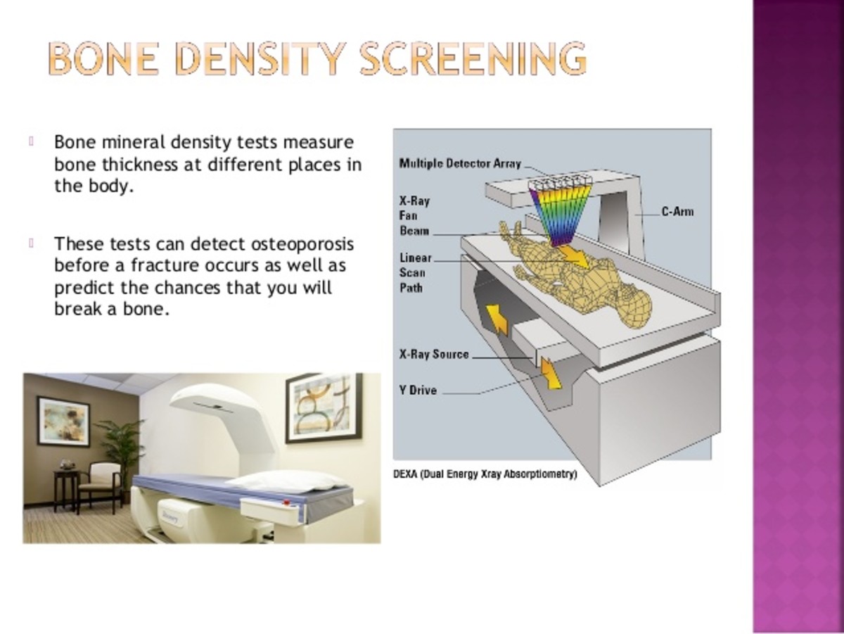 Lupus and Bone Density Scanning