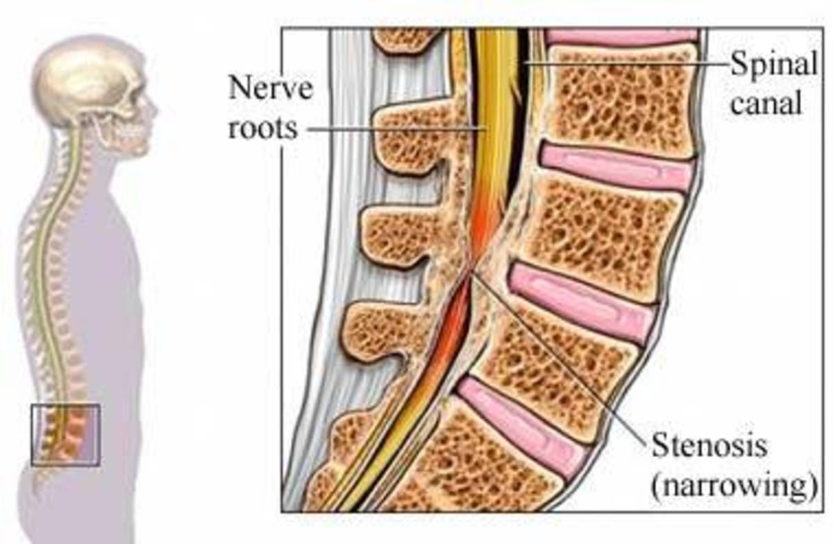 spinal-stenosis-treatment