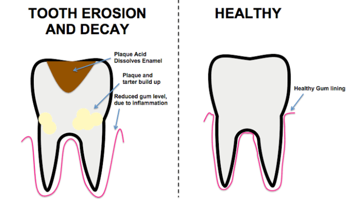 How Can I Protect My Teeth from Tooth Erosion?