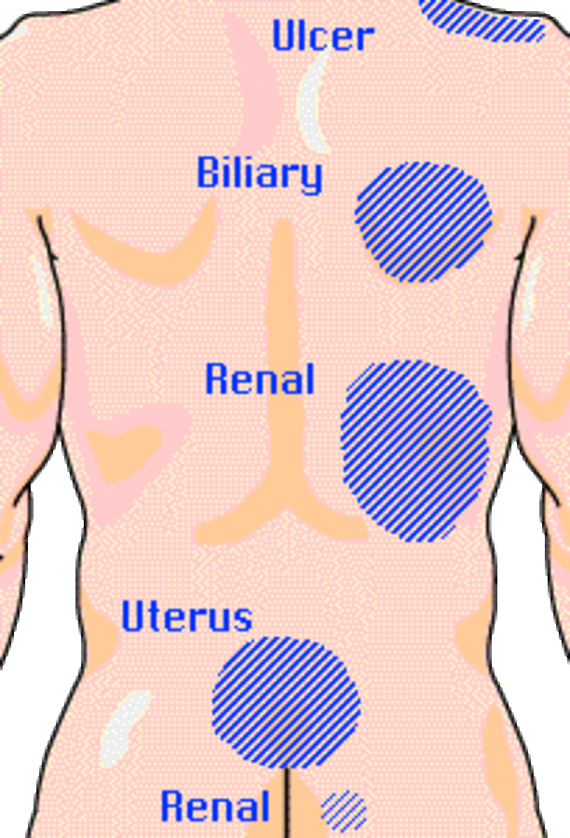 Topographic locations of some areas of pain. Visual site of renal colic