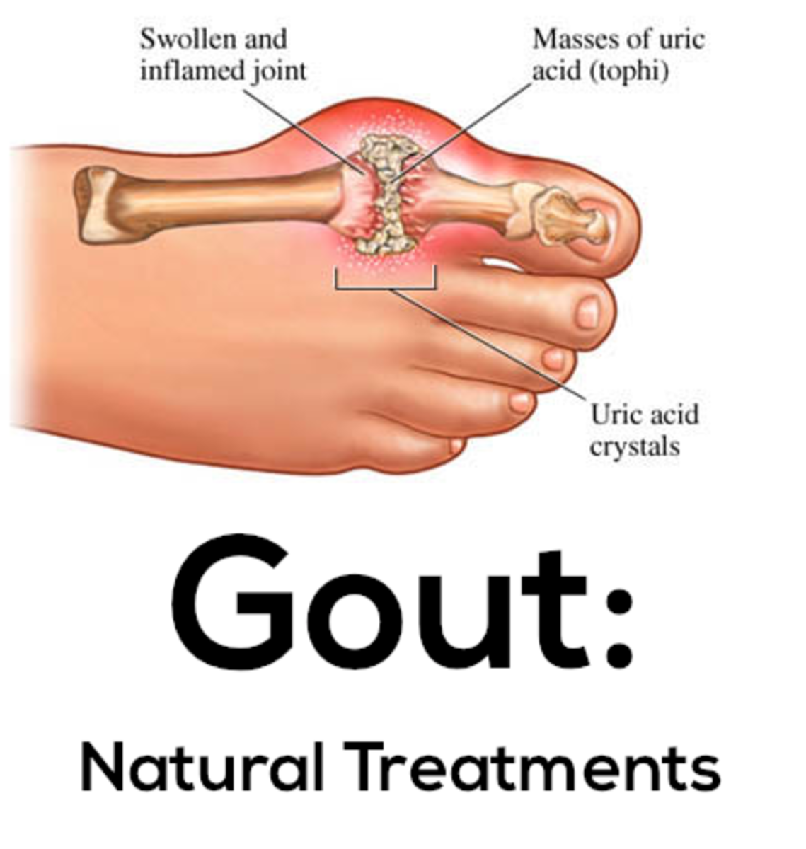best-natural-remedy-for-gout