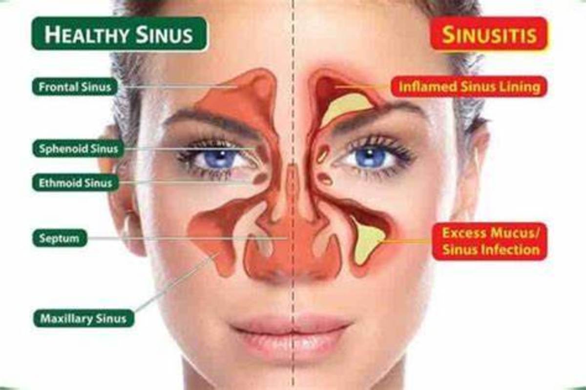 Sinusitis: Types and Causes, Symptoms & Preventions, or Remedies
