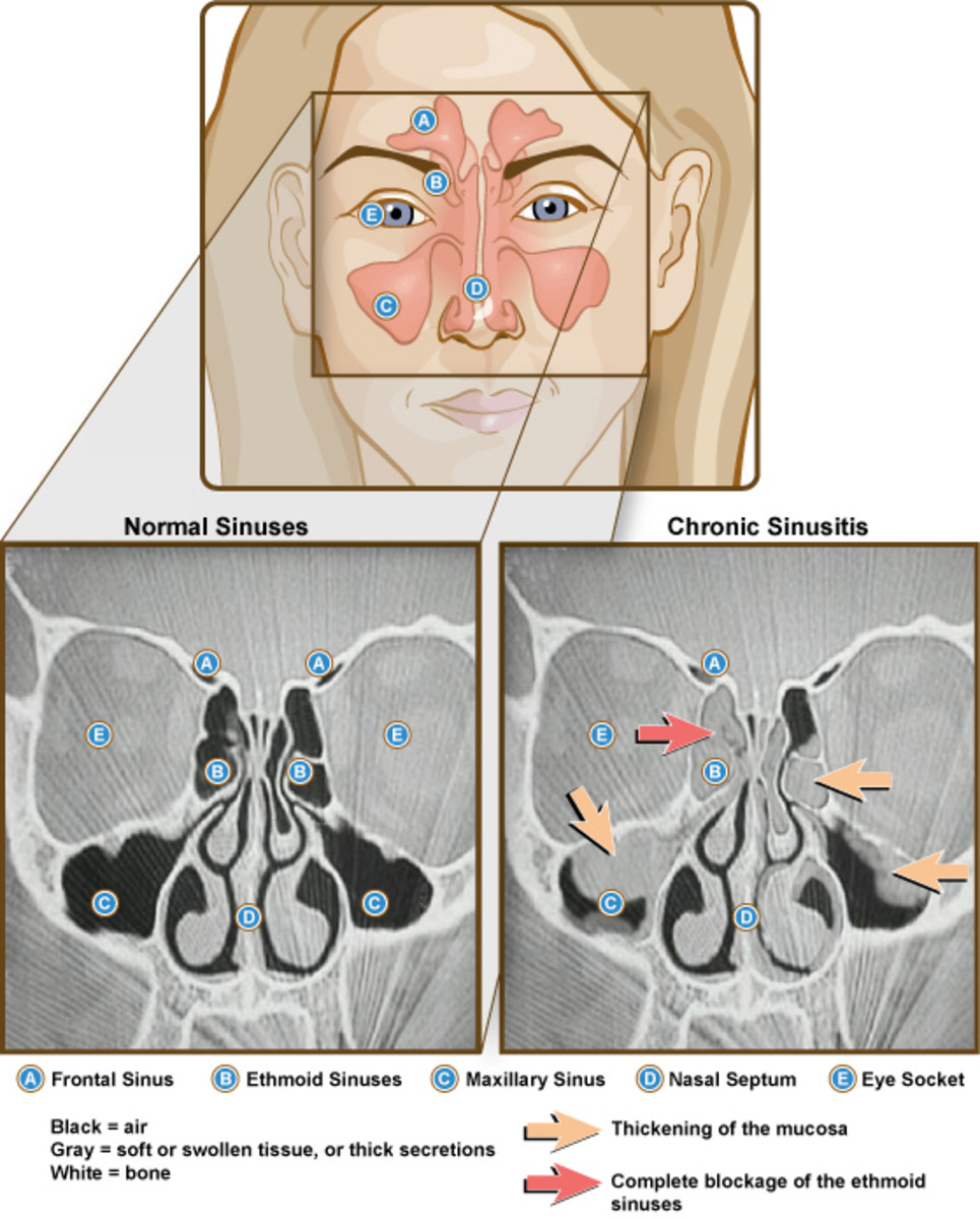 Sinusitis Types and Causes, Symptoms & Preventions, or Remedies HubPages