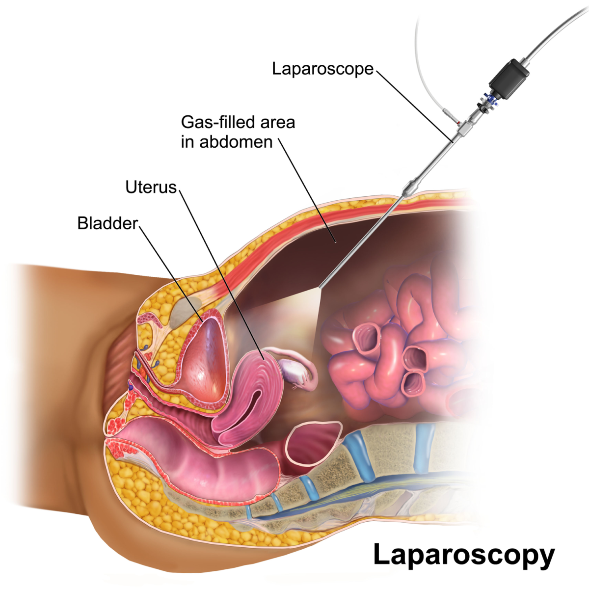 my-experience-of-pcos-and-laparoscopy