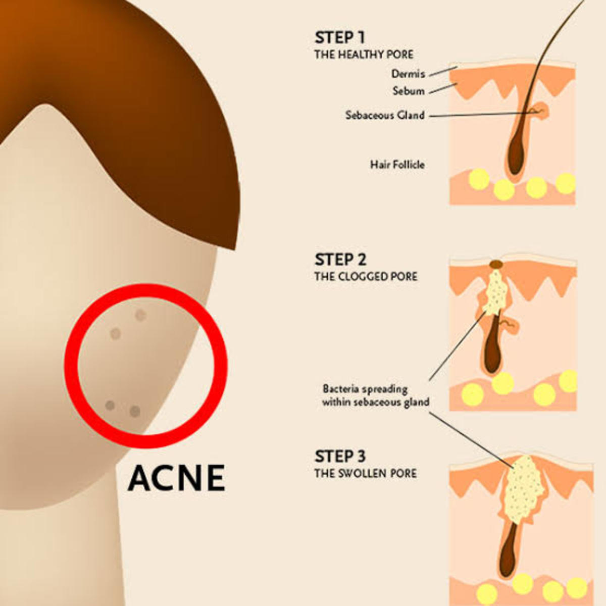 Say Goodbye to Acne, Top Remedies for Acne